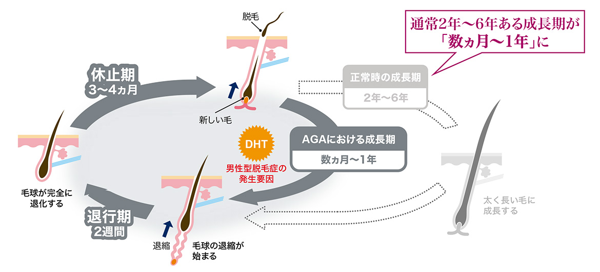 AGA男性のヘアサイクル